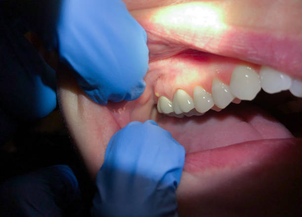 Best Emergency Dentist for Lost Fillings or Crowns in Carroll Valley, PA