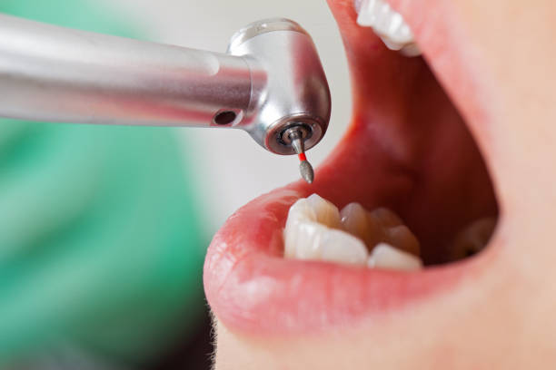 Best Emergency Dentist for Lost Fillings or Crowns in Carroll Valley, PA